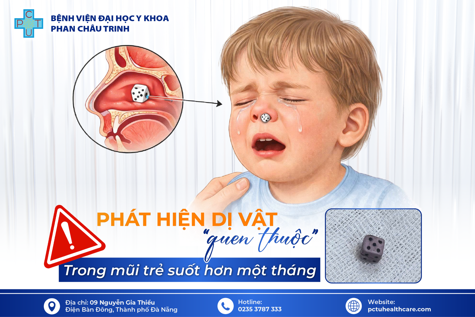 Dị vật mũi ở trẻ em: phát hiện sớm để tránh biến chứng nguy hiểm
