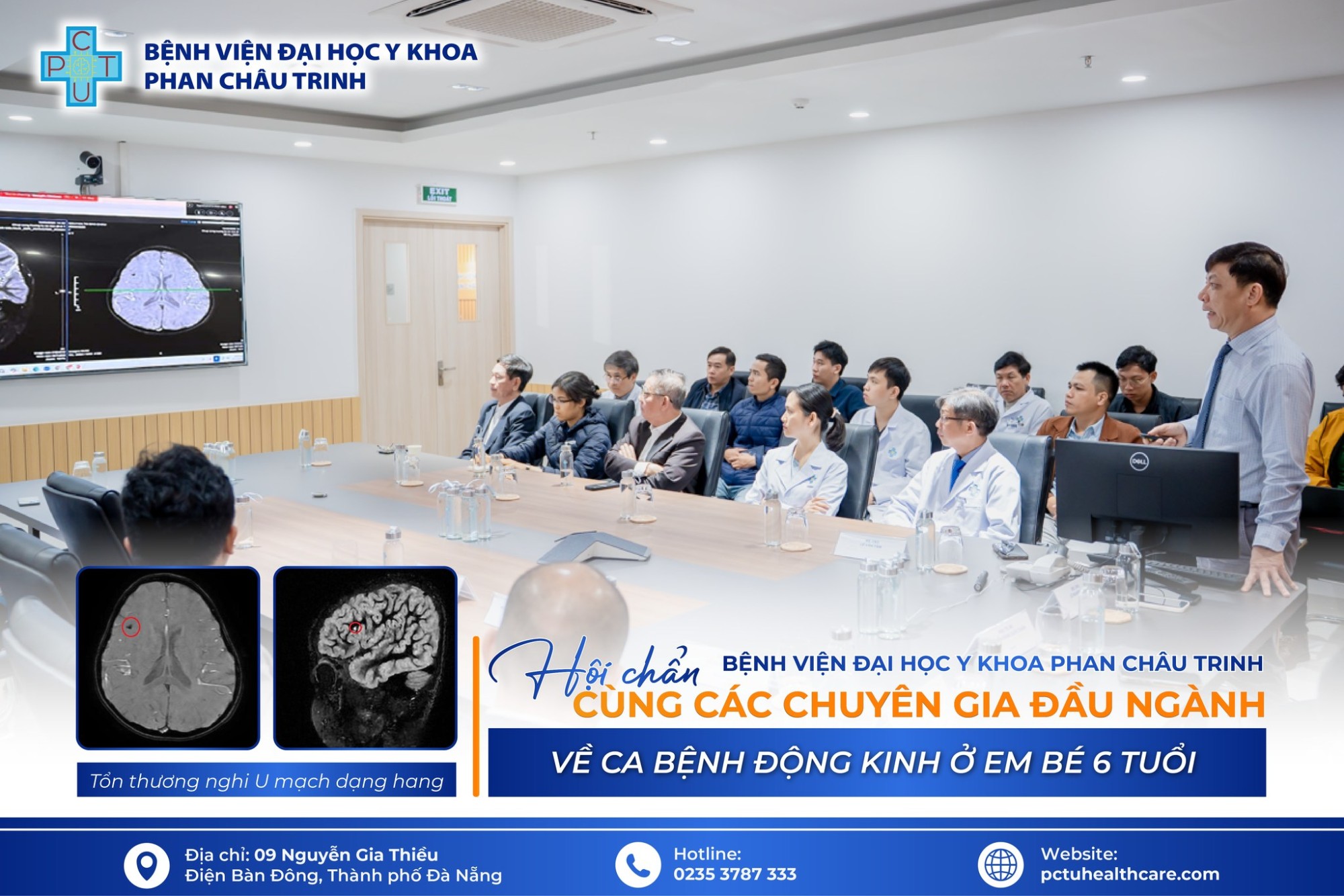 Hội chẩn ca động kinh: Giải pháp tối ưu trong chẩn đoán và điều trị bệnh nhi 6 tuổi