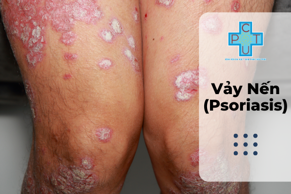 Vảy Nến (Psoriasis)