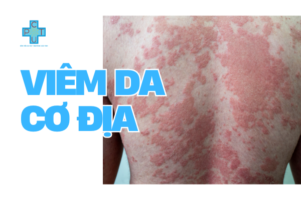 Viêm Da Cơ Địa (Atopic Dermatitis)