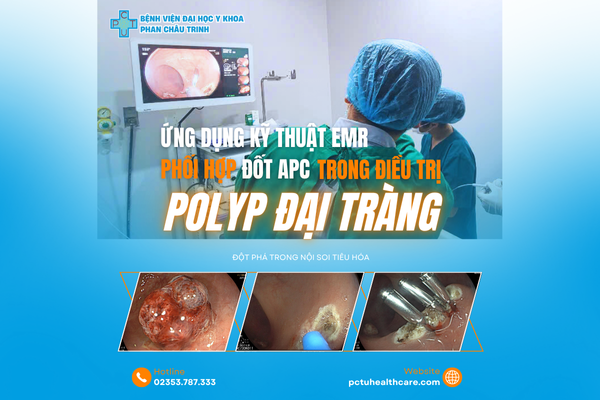 Hiệu quả từ kỹ thuật EMR kết hợp đốt Argon (APC) trong điều trị polyp đại tràng