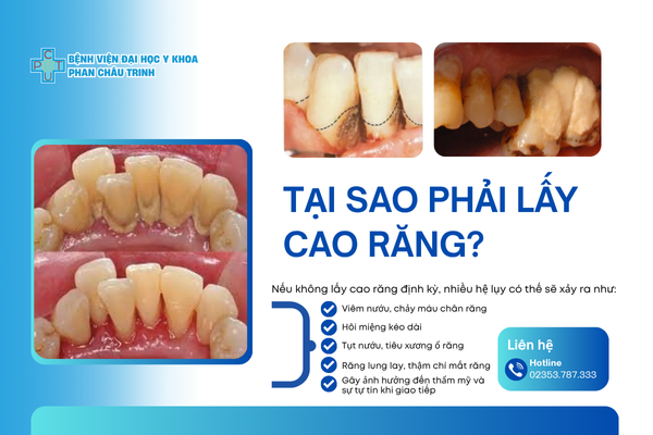 Tại sao phải lấy cao răng?
