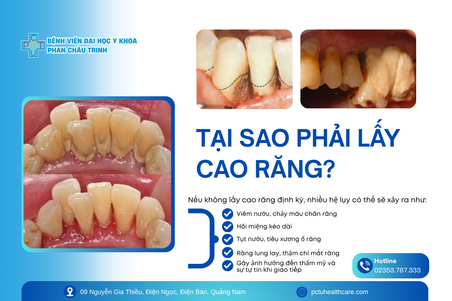 tai_sao_phai_lay_cao_rang_4