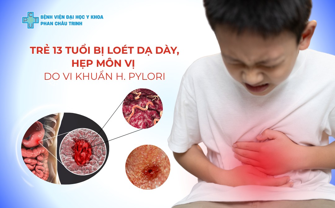 Cảnh Giác Với Đau Bụng Kéo Dài Ở Trẻ Em – Trường Hợp Loét Dạ Dày, Hẹp Môn Vị Do H. pylori