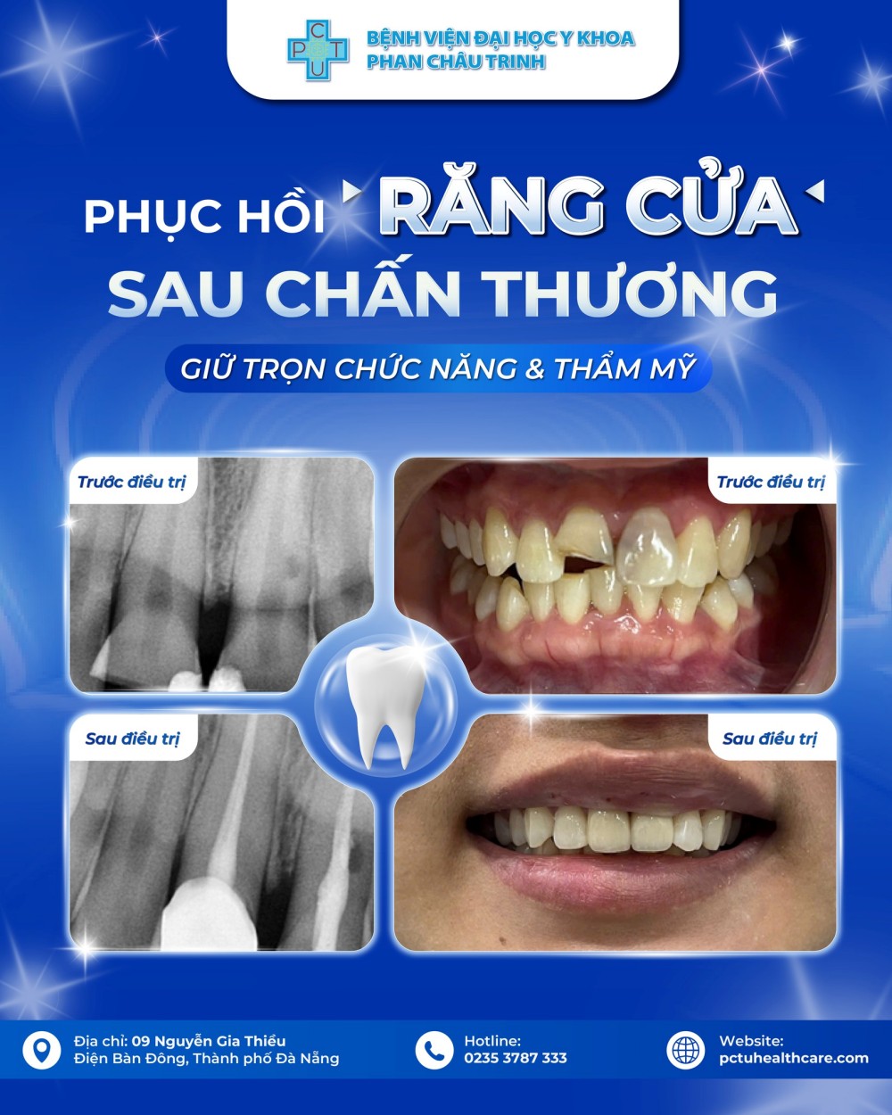 Gay_rang_cua_do_chan_thuong
