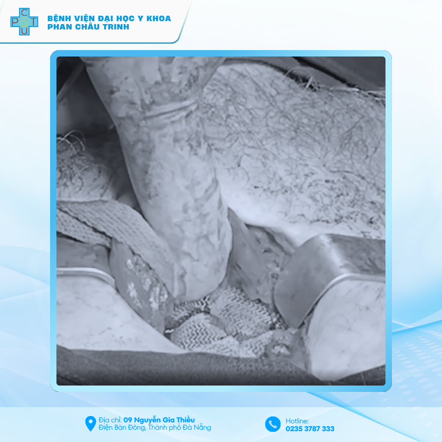 THOAT_VI_BEN_PHUC_TAP_3