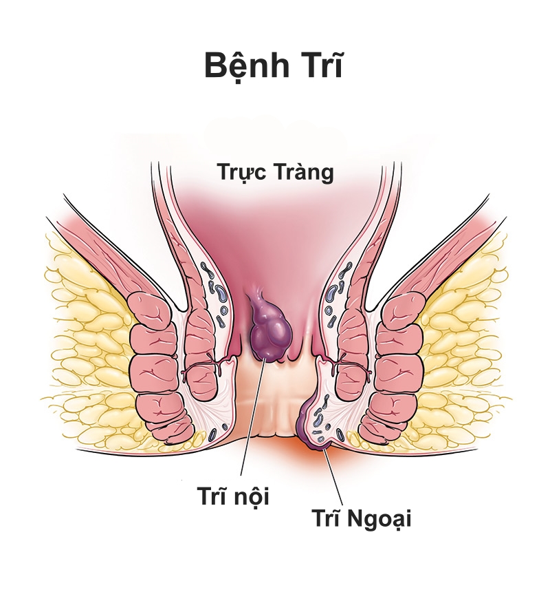 benh_tri