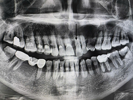 case_implant_viem_nha_chu