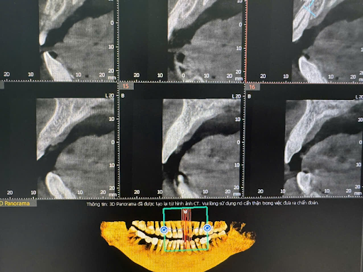 case_implant_viem_nha_chu_1