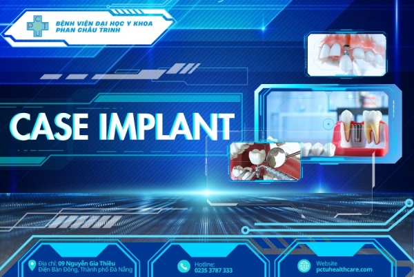 Cấy implant răng cửa – Giải pháp tối ưu khi răng mất do viêm nha chu