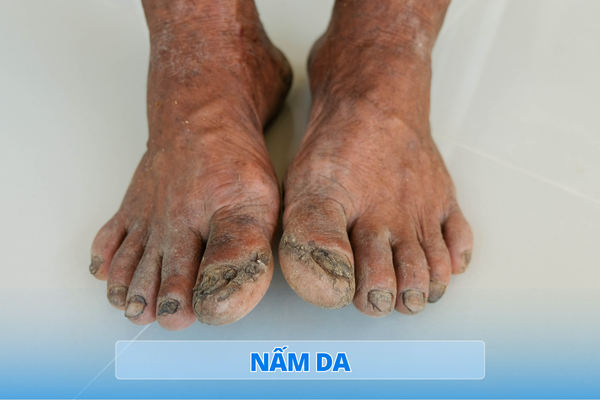 Nấm Da (Dermatophytes Infection)