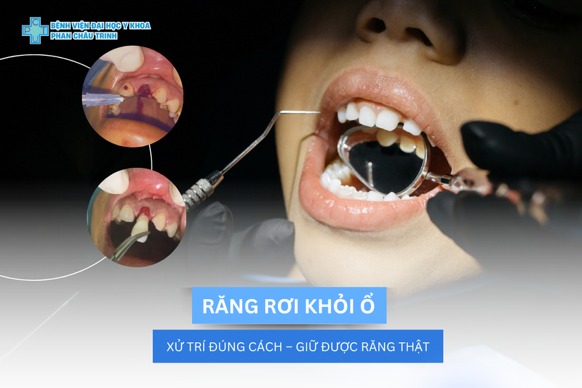 rang_roi_khoi_o_2