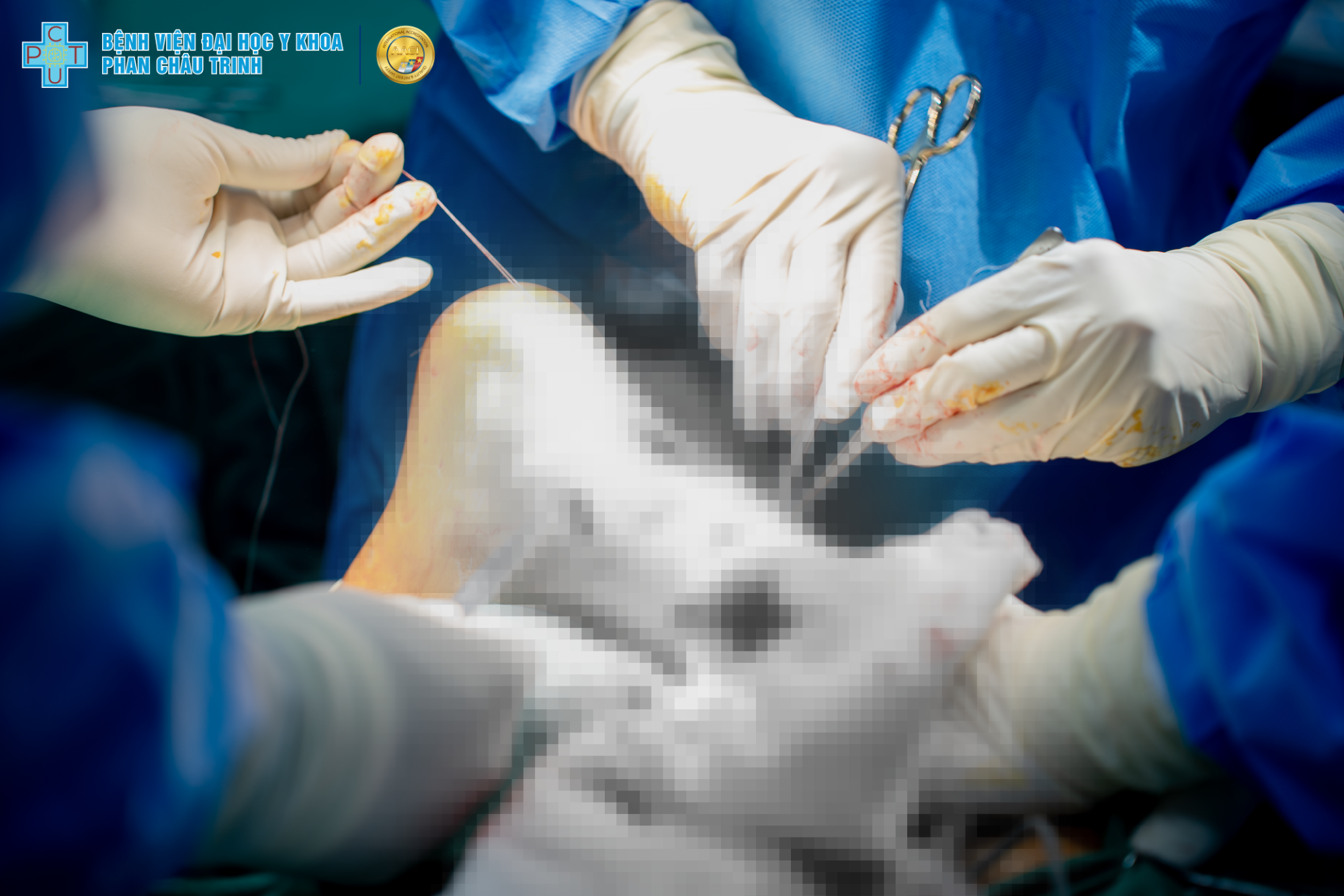 Chấn thương khi chơi cầu lông, nam thanh niên người Nga đứt hoàn toàn gân gót