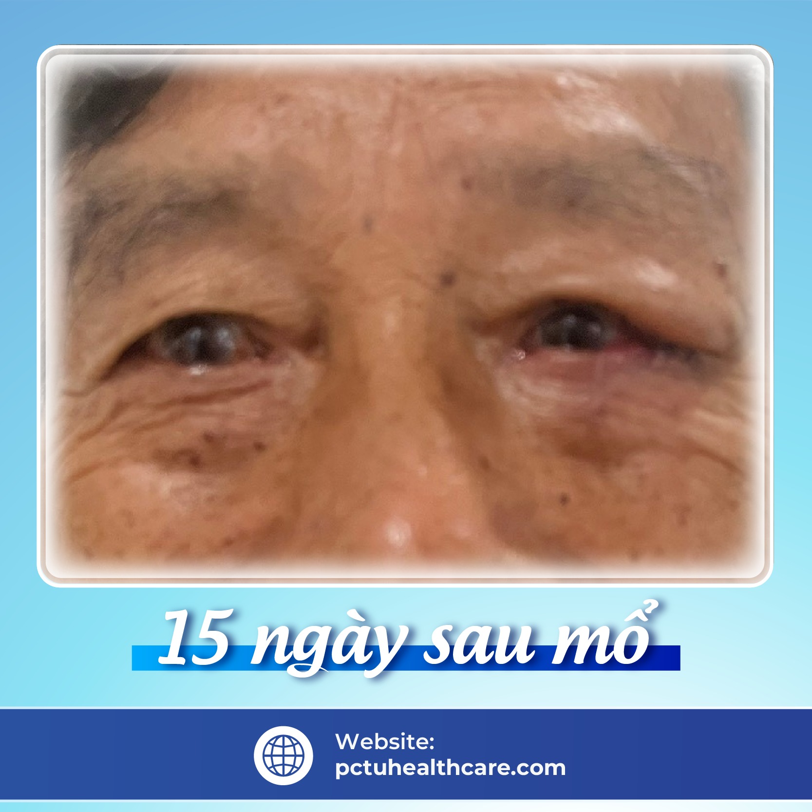 mo_ung_thu_da_mi_mat_2