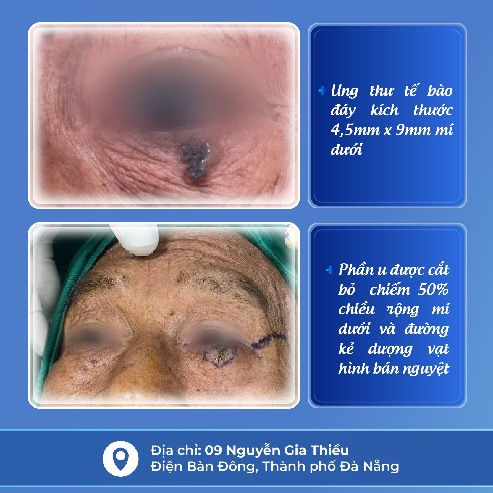 ung_thu_da_mi_mat_tai_pctu