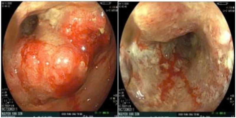 BVPTC-ung_thu_dai_trang_1