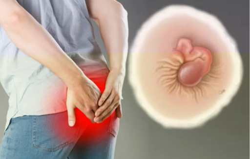 Bệnh trĩ – Căn bệnh thầm lặng, đừng để “ngại” khiến bạn chịu đau