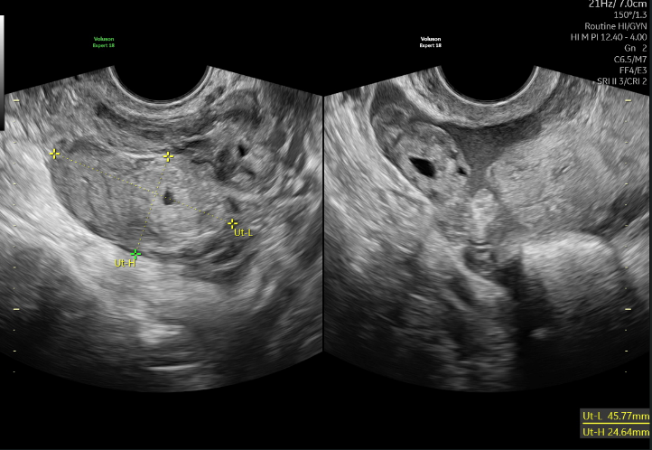 hinh_anh_sieu_am_tu_cung_phan_phu