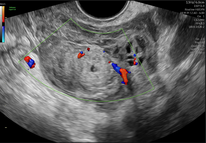 hinh_anh_sieu_am_tu_cung_phan_phu_1