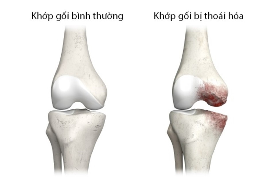 Thoái hóa khớp gối: Nguyên nhân, dấu hiệu và giải pháp