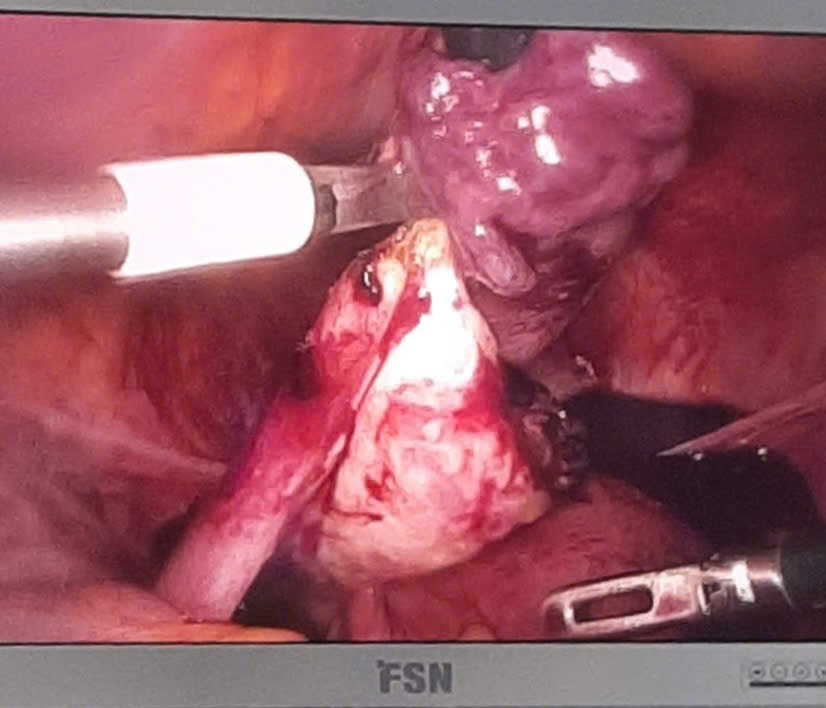 thai_ngoai_tu_cung_pctu_1