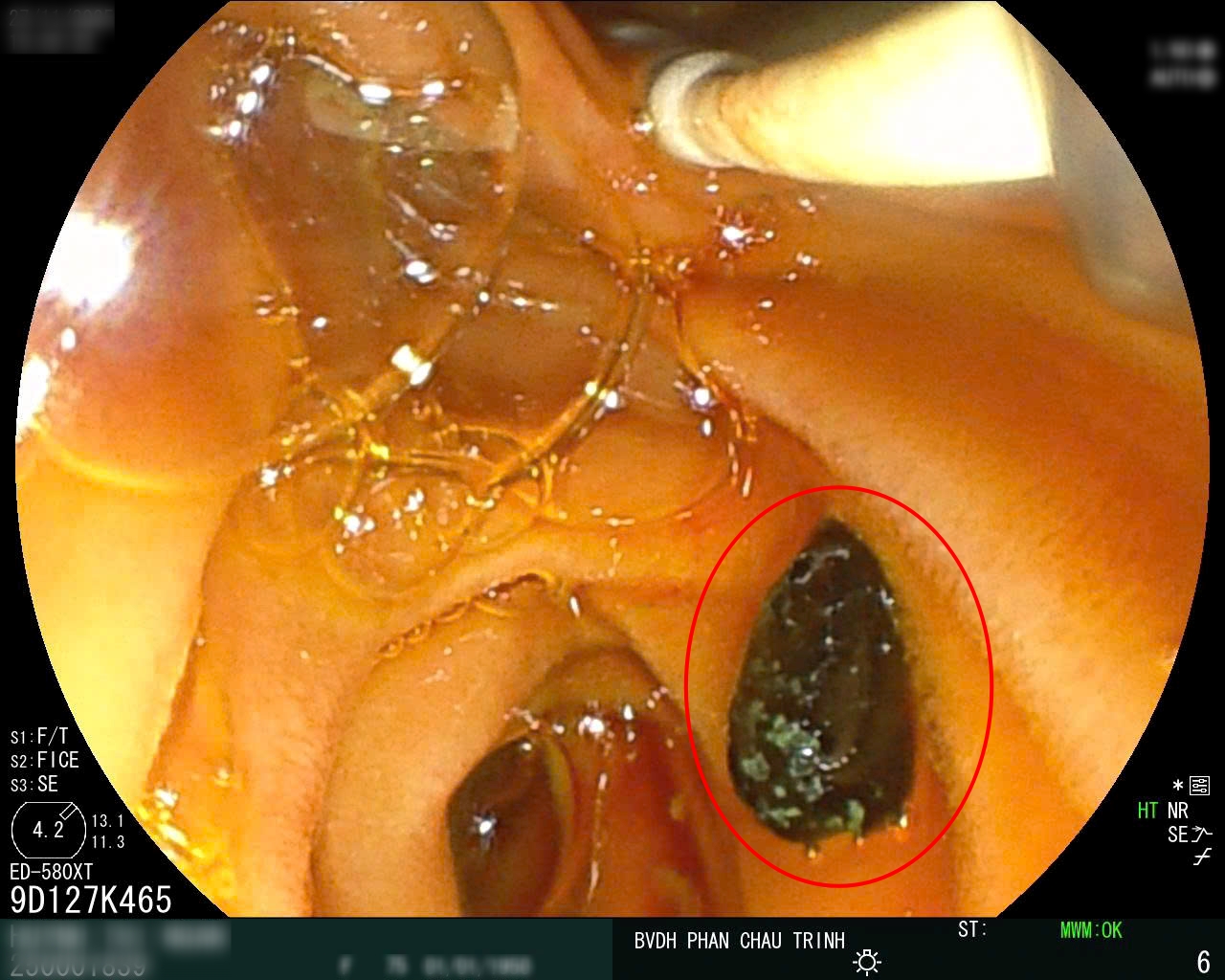 hinh anh sieu am soi tui mat